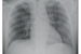 Point-of-Care Lung Ultrasound findings in novel coronavirus disease-19 pnemoniae